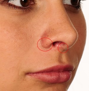 Phương pháp khắc phục sẹo lồi sau nâng mũi