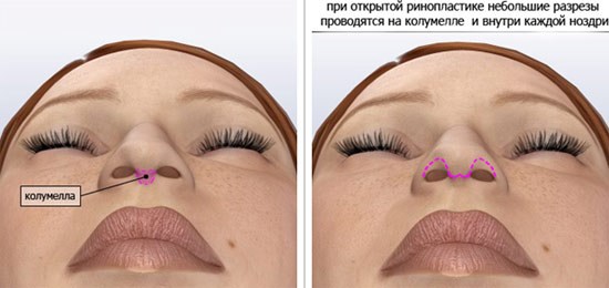 Metody korekcji blizn keloidowych po korekcji nosa