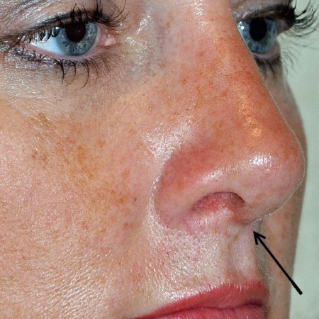 Metody korekcji blizn keloidowych po korekcji nosa