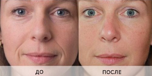 Biorewitalizacja twarzy. Techniki, etapy przebiegu, cechy zabiegu