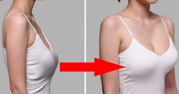 Nâng ngực bằng túi độn hình giọt nước trong tạo hình tuyến vú. Ảnh trước và sau