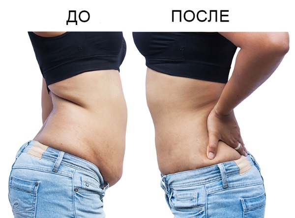 A has zsírleszívása - típusok, fotók előtt és után, vélemények