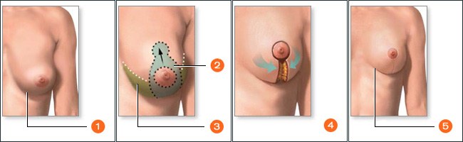 Tạo hình có vú - phẫu thuật tạo hình tuyến vú.Hình ảnh trước và sau, chi phí, đánh giá