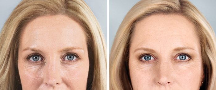 Fotorejuvenecimiento de rostro y cuerpo. Qué es, pros y contras, fotos antes y después, precio