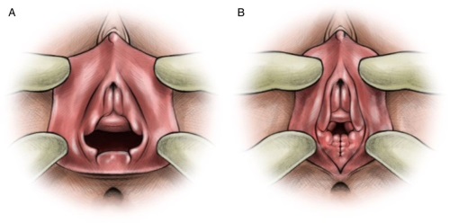 Hymenoplastyka - co to jest, zdjęcia przed i po, etapy operacji, wyniki, rehabilitacja i możliwe powikłania