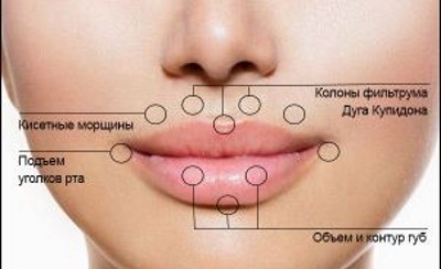 Contorno de labios: una técnica de aumento con ácido hialurónico, rellenos. Fotos y precios
