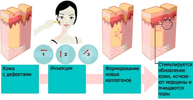 Liệu pháp Plasma - Plasmolifting của da mặt và cổ, chỉ định, chống chỉ định, hình ảnh, giá của thủ thuật, đánh giá