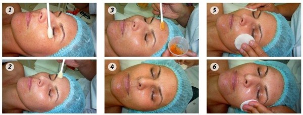 Peeling chimique du visage - qu'est-ce que c'est, comment se fait-il à la maison, types et caractéristiques