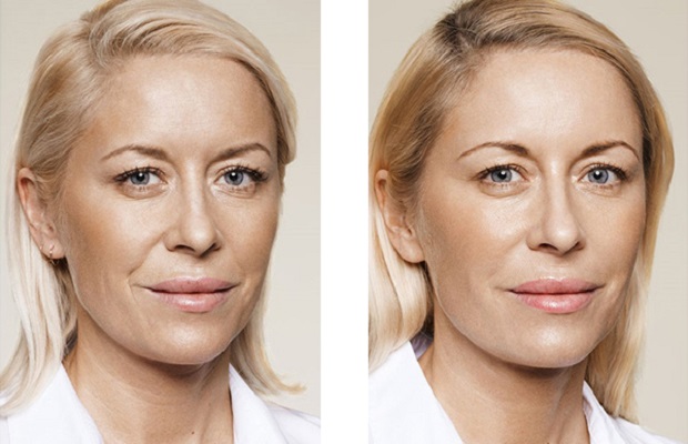 Biorevitalización del rostro, labios, manos, cuello, contorno de ojos. Efecto después del procedimiento. Precio. Fotos antes y después. Reseñas