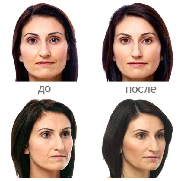 Axit hyaluronic cho mặt: cách tiêm, kết quả, ảnh trước và sau khi tiêm, đánh giá