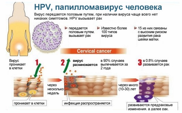 Le VPH chez la femme - qu'est-ce que c'est, symptômes, types, comment se transmet-il, traitement du papillomavirus humain en gynécologie