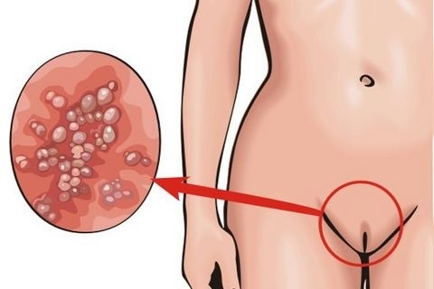 HPV u kobiet - co to jest, objawy, rodzaje, sposób przenoszenia, leczenie wirusa brodawczaka ludzkiego w ginekologii