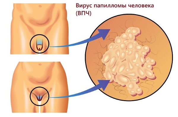 VPH en dones: què és, símptomes, tipus, com es transmet, tractament del virus del papil·loma humà en ginecologia