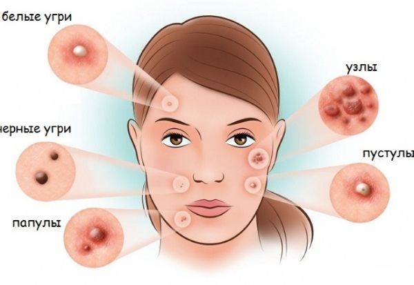 Pommade à la tétracycline pour l'acné sur le visage. Mode d'emploi, photos, avis, prix