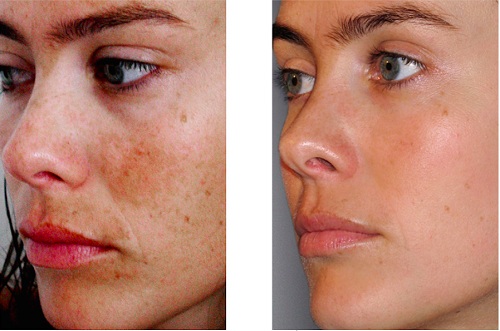 Peeling chimique pour le visage au salon et à la maison. Avis, photos avant et après, avantages et inconvénients