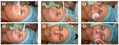 Peeling químico para el rostro en el salón y en casa. Reseñas, fotos de antes y después, pros y contras