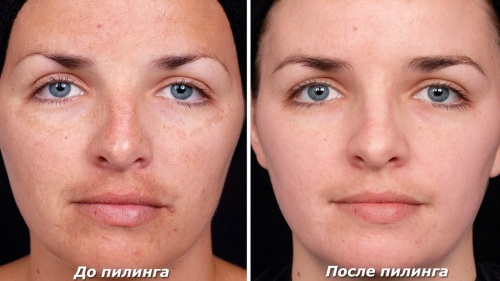 Peeling chimique pour le visage au salon et à la maison. Avis, photos avant et après, avantages et inconvénients