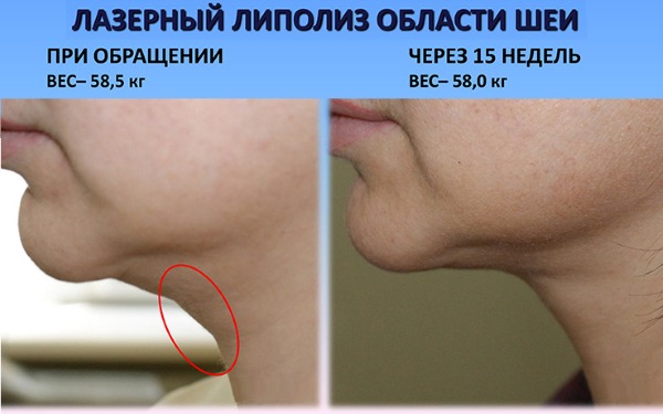 Liposucció de la barbeta amb làser. Fotos, com es realitza el procediment, el període de rehabilitació, les conseqüències, les revisions