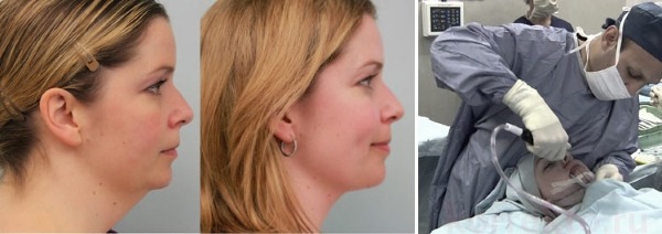 Liposucció de la barbeta amb làser. Fotos, com es realitza el procediment, el període de rehabilitació, les conseqüències, les revisions