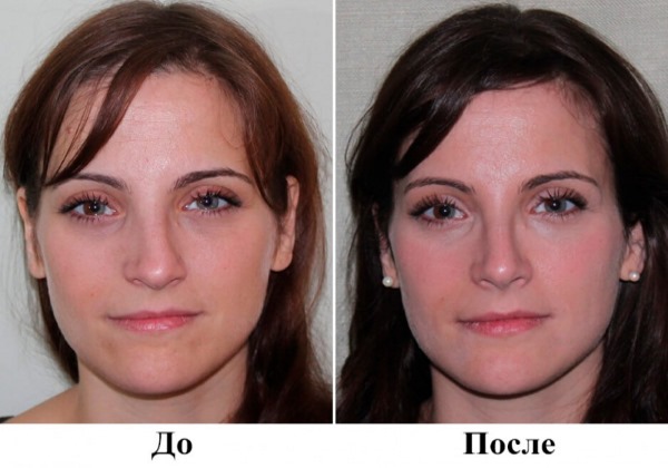 Phẫu thuật vẹo vách ngăn mũi: giai đoạn hậu phẫu, chăm sóc mũi sau chỉnh sửa, phục hồi chức năng. Một bức ảnh