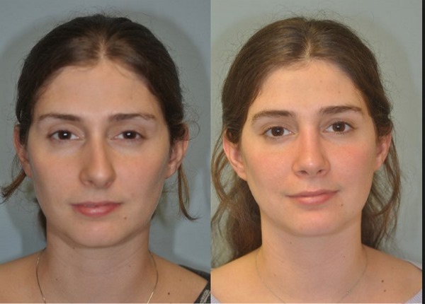 Phẫu thuật vẹo vách ngăn mũi: giai đoạn hậu phẫu, chăm sóc mũi sau chỉnh sửa, phục hồi chức năng. Một bức ảnh