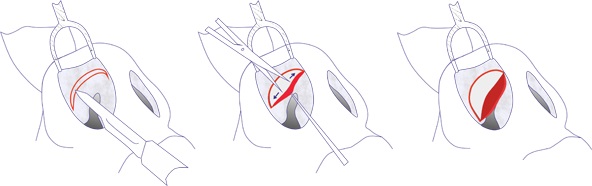 Phẫu thuật thu gọn cánh mũi: cánh, đầu mũi, cách họ làm, ảnh trước và sau