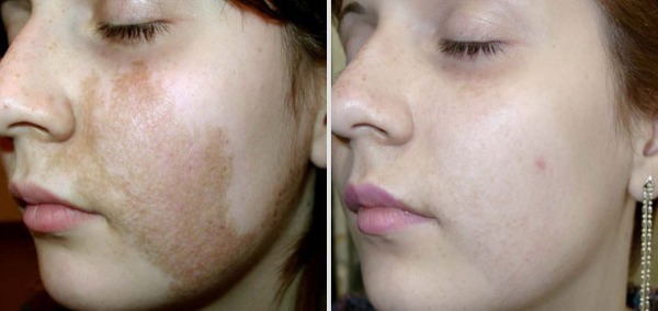 Pigmentation sur le visage. Causes et traitement à domicile. Crèmes, pommades, remèdes populaires, masques, élimination au laser