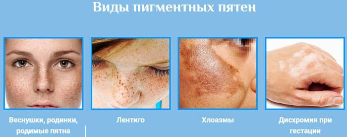 Pigmentació a la cara. Causes i tractament a casa. Cremes, ungüents, remeis populars, màscares, eliminació de làser
