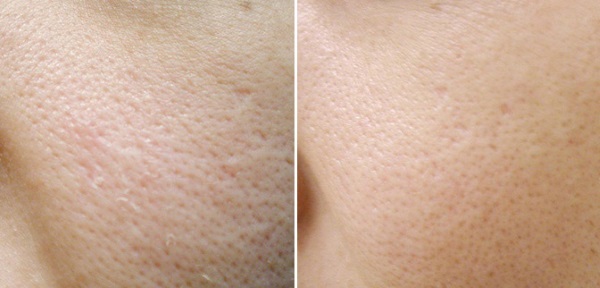 Ácido acetilsalicílico para la piel del rostro. Recetas para mascarillas, peeling para el acné, arrugas. Resultados y fotos