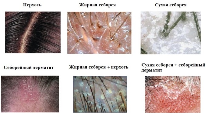 Các loại dầu gội tốt nhất cho da đầu bị gàu, ngứa và khô: Heden Sholders, Clear, Estelle, Weireal, Cynovit, Sebazol