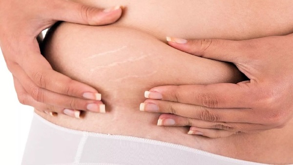 Làm thế nào để hết rạn da, xóa mờ trên ngực, bụng, mông, cơ thể, chân, hông sau khi sinh con, khi mang thai. Kem, dầu, xác ướp, loại bỏ laser