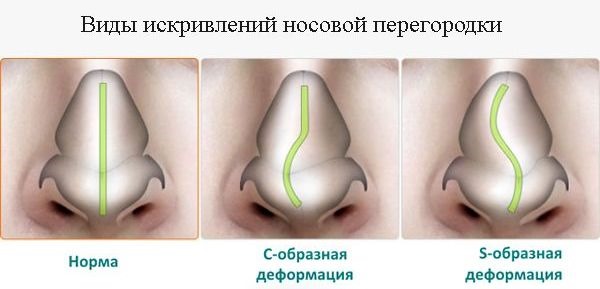 Septoplastia del tabique nasal.¿Qué es este láser, endoscópico, de ondas de radio? Postoperatorio, consecuencias