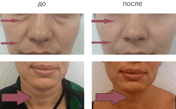 Karboxiterápia - mit jelent az arc a kozmetológiában: nem injekció, nem invazív, injekció. Fotók előtt és után, ár, vélemények