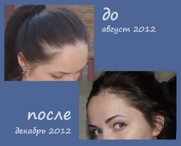 Axit nicotinic cho sự phát triển của tóc. Chỉ định, hướng dẫn sử dụng ở dạng ống, viên nén, mặt nạ. Nhận xét của các nhà trichologists