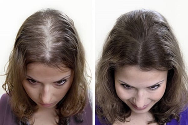 Terapia plazmowa włosów i skóry głowy: co to jest, wyniki, wskazania i przeciwwskazania