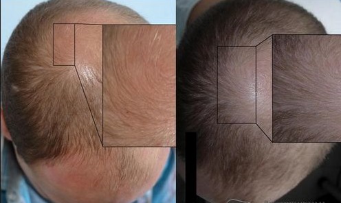 Terapia plazmowa włosów i skóry głowy: co to jest, wyniki, wskazania i przeciwwskazania