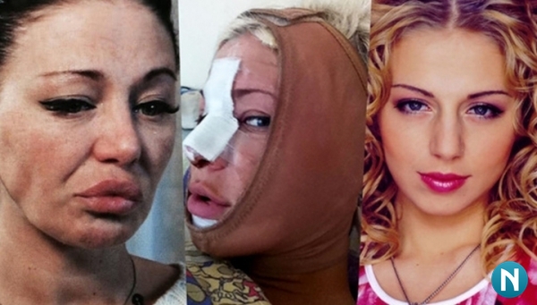 Các ngôi sao trước và sau khi phẫu thuật thẩm mỹ. Ảnh Nga, Hollywood, Hàn Quốc, không thành công, nạn nhân, Instagram, tại nhà 2