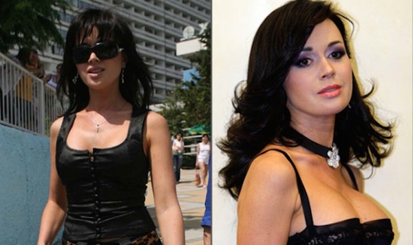 Nữ diễn viên Nga ngực khủng trước và sau khi phẫu thuật thẩm mỹ. Một bức ảnh