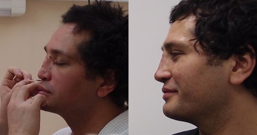 Rustam Solntsev przed i po operacji plastycznej. Zdjęcie, jak to wygląda teraz