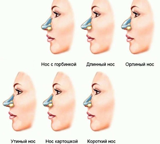 Hogyan lehet rögzíteni a nő orrát burgonyával. Orrplasztika, fotó műtét előtt és után, ár