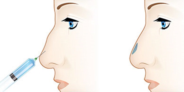 Nâng mũi không phẫu thuật bằng chất làm đầy, thuốc. Ảnh trước và sau, giá cả