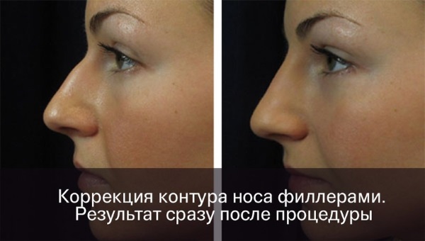 Az orr hegyének nem műtéti orrplasztikája töltőanyaggal, gyógyszerekkel. Fotók előtt és után, ár