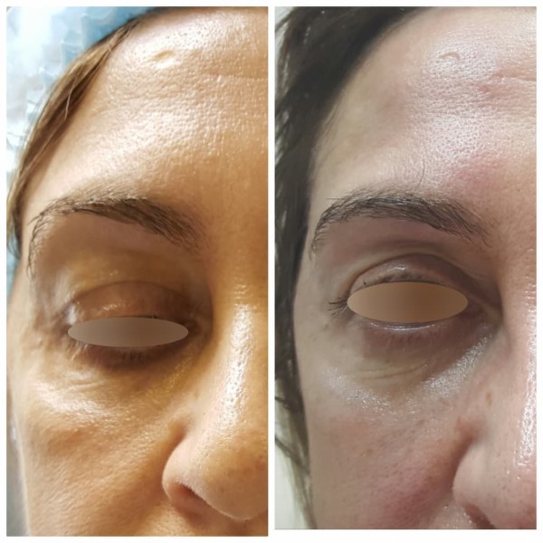 Тиндаллов ефекат у козметологији испод очију, на кожи усана. Када се посматра како се уклања