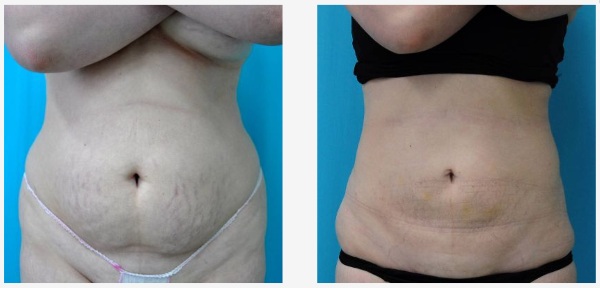 Non-kirurhiko liposuction ng tiyan. Larawan bago at pagkatapos ng laser, ultrasound, mga pagsusuri, presyo