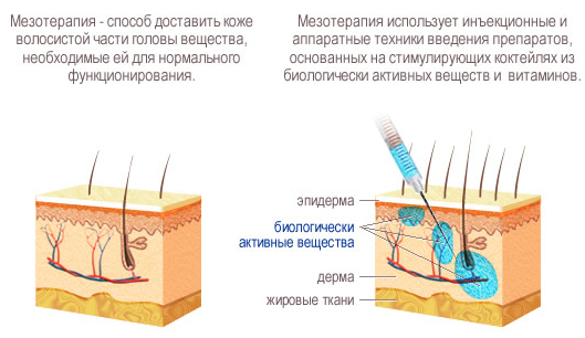 Dermahil cho tóc trong liệu pháp mesotherapy. Thành phần, ảnh trước và sau, hướng dẫn sử dụng