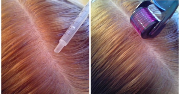 Dermahil cho tóc trong liệu pháp mesotherapy. Thành phần, ảnh trước và sau, hướng dẫn sử dụng