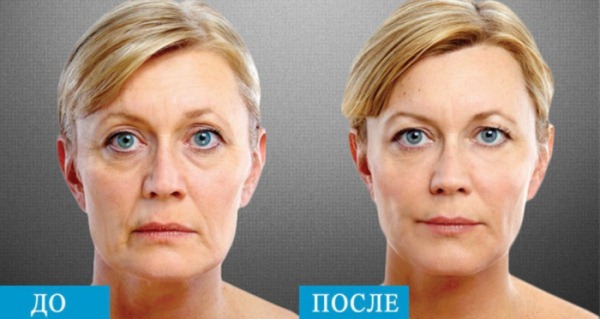 Dermahil lipolítico en mesoterapia para el rostro. Fotos antes y después, precio, reseñas