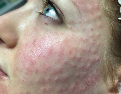 Dermahil lipolítico en mesoterapia para el rostro. Fotos antes y después, precio, reseñas