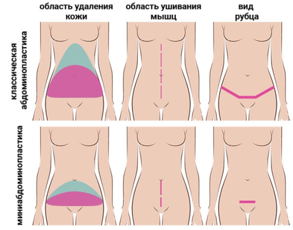 Mini plastyka brzucha. Zdjęcia przed i po, rehabilitacja, wyniki, cena, recenzje