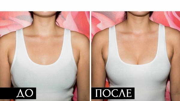 Levantamiento de senos con y sin implantes. Fotos antes y después, cómo hacer, precios.